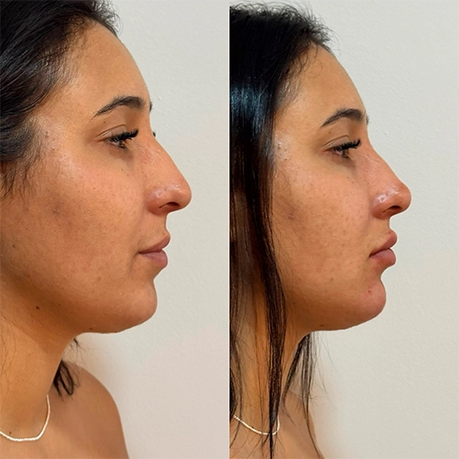 ANTES E DEPOIS 1 - DR DIOGO