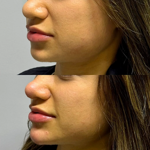 ANTES E DEPOIS 10 - DR DIOGO