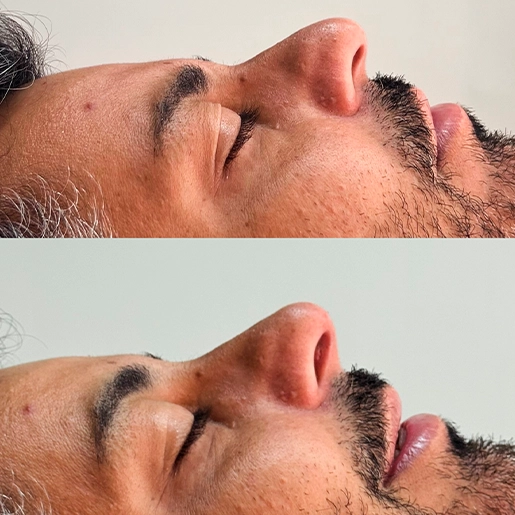 ANTES E DEPOIS 3 - DR DIOGO