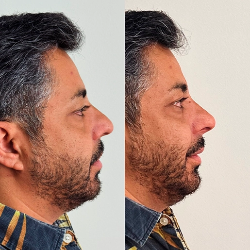 ANTES E DEPOIS 4 - DR DIOGO