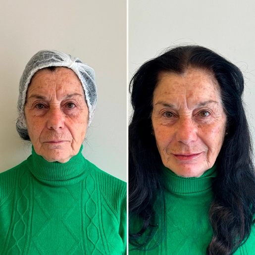 ANTES E DEPOIS 5 - DR DIOGO