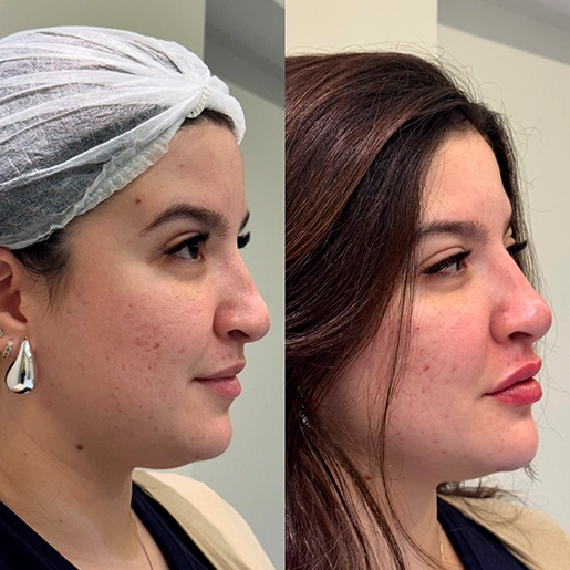ANTES E DEPOIS 9 - DR DIOGO